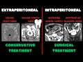 Intraperitoneal vs Extraperitoneal Bladder Rupture CT Explained within 2 Minutes