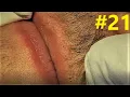 BLACKHEADS EXTRACTIONS on Happy s Upper Lip