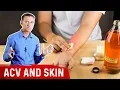 Will Apple Cider Vinegar Burn Your Skin or Heal It - Dr Berg