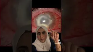 مخاطر الاستخدام الخاطئ للعدسات اللاصقة  مخاطر الاستخدام الخاطئ للعدسات اللاصقة
