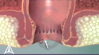 What is an anal fissure 3D animation
