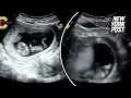 WATCH Ultrasound footage shows what happens when an expecting mother laughs during pregnancy