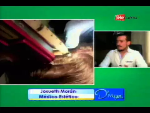 Mesoterapia capilar contra la caída del cabello