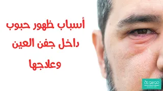 ما سبب ظهور حبوب جفن العين وتشخيصها وعلاجها 