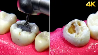 Restauraciones estéticas en dientes posteriores