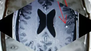 יהודה הבר צוללן השייטת שהחלים מגידול סרטני במוחו 