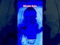 Download Lagu High Bilrobin Baby IV line Phototharapy Start