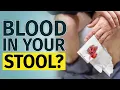 Download Lagu BLOOD IN STOOL | Other Signs You Have to Check