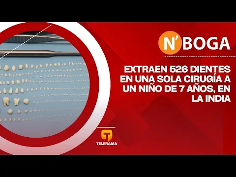 Extraen 526 dientes en una sola cirugía a un niño de 7 años, en la india