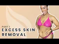Bryanna s Journey The Consultation and AbEX Tummy Tuck Alternative Pre-Op