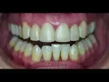 Composite resin before and after (2014) - Cosmetic DSD restorative dentistry dental smile design