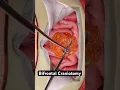 Download Lagu Removing a tumor from your brain (3D Animation)
