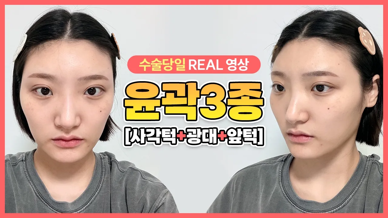 윤곽3종 수술 후기! 광대+사각턱+앞턱 삭제... 이제 보정 없이도 매끈한 얼굴형✨