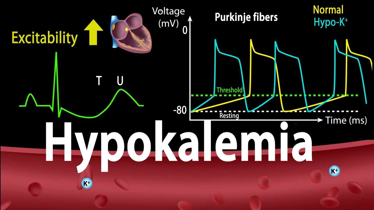 Hypokalemia: Causes, Symptoms, Effects on the Heart, Pathophysiology, Animation.