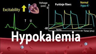 Hypokalemia Causes Symptoms Effects on the Heart Pathophysiology Animation