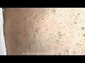 Big Cystic Acne Blackheads Extraction Blackheads Milia Whiteheads Removal Pimple Popping
