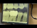 Gold Crown Tooth X-Ray
