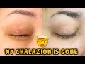 Lagu Update: My Chalazion is Gone!!! | How did I get rid of it??