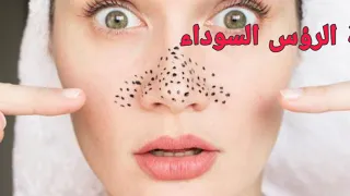 الطريقة الوحيدة للتخلص من الرؤوس السوداء من اول استعمال اقسم بالله 