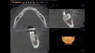 Dentigerous cyst confirmed