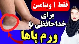 فقط ۱ ویتامین معجزه آسا برای رفع دائمی ورم پاها ساق پا و مچ پا  علت و درمان ورم پا دندنها