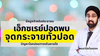 การรักษาโรคปอดที่มีจุดกระจายแต่ไม่มีอาการควรทำอย่างไร