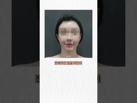 #prp주사 #prp주사란 #prp주사피부 #리커버리주사 #메종프리베 #연예인피부과 #압구정피부과 #한국미용피부과 #한국미용클리닉 #한국미용투어