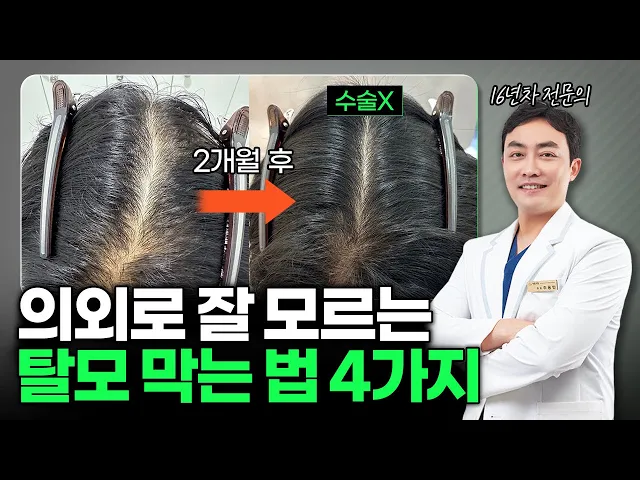 더이상 빠지지 않는 탈모치료 방법/과정 전부 알려드립니다. (머리카락 나게 하는 법)