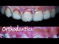 Multi Disciplinary Dentistry   #dsd #crownlenghtening #orthodontic #veneers