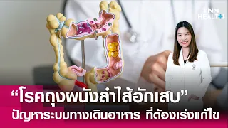  การรักษาโรคถุงผนังลำไส้อักเสบ แตกต่างกันอย่างไรในกรณีที่มีภาวะแทรกซ้อน 