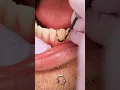 ASMR teeth scaling at the dentist