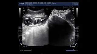 Ultrasound showing Pyonephrosis associated with pyoureter