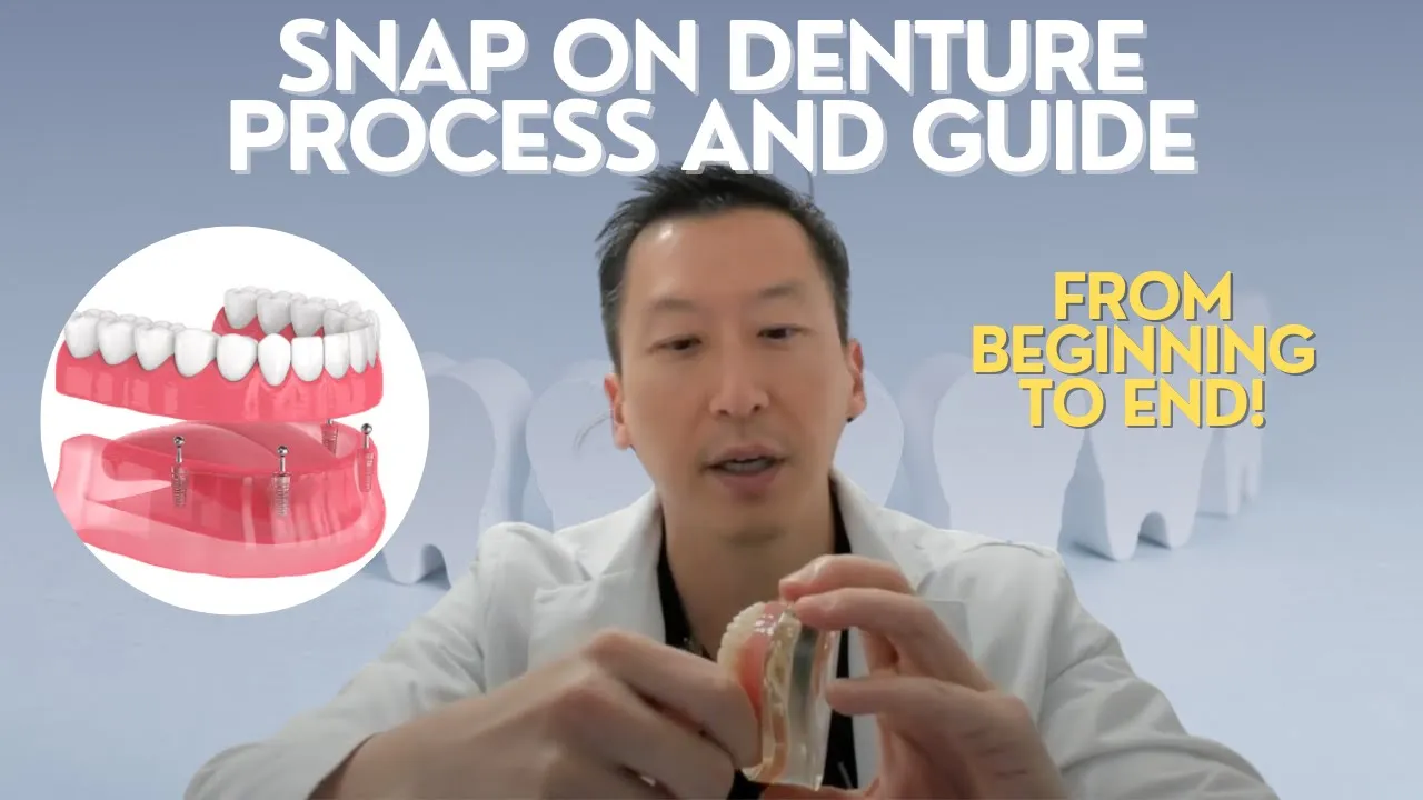 Outline Video Snap on denture steps