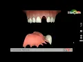 Temporary Replacement Tooth Flipper