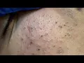 Say Goodbye to Blackheads with This Facial Care Routine By Sac Dep Spa
