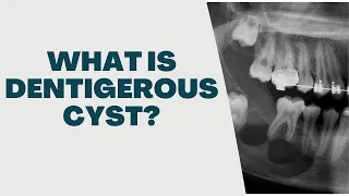 What is Dentigerous Cyst 4 Possible Complications