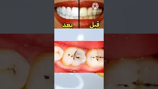 اسرع طريقة لعلاج تسوس الاسنان ولتبييض الاسنان وإزالة الجير والإصفرار وإزالة رائحة الفم الكريهة 