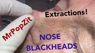 I exorcised the pores! This nose is clear. Deep nose extractions, can’t stop the pop!