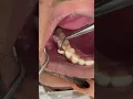 Download Lagu tooth fracture #broken #tooth#fyp #video #foryou #tiktok #viral #tiktok #trending #love #foryou