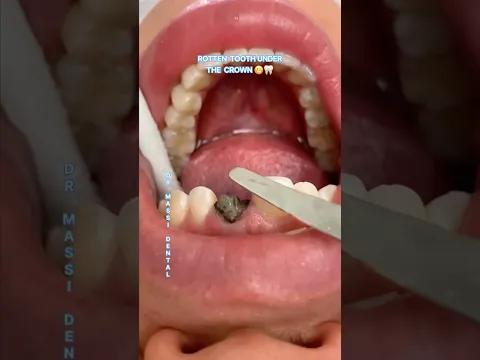 Rotten Tooth Under the Crown 😬🦷