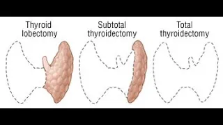 Thyroid lobectomy Sub total Completion thyroidectomy Radical Isthmusectomy Substernal