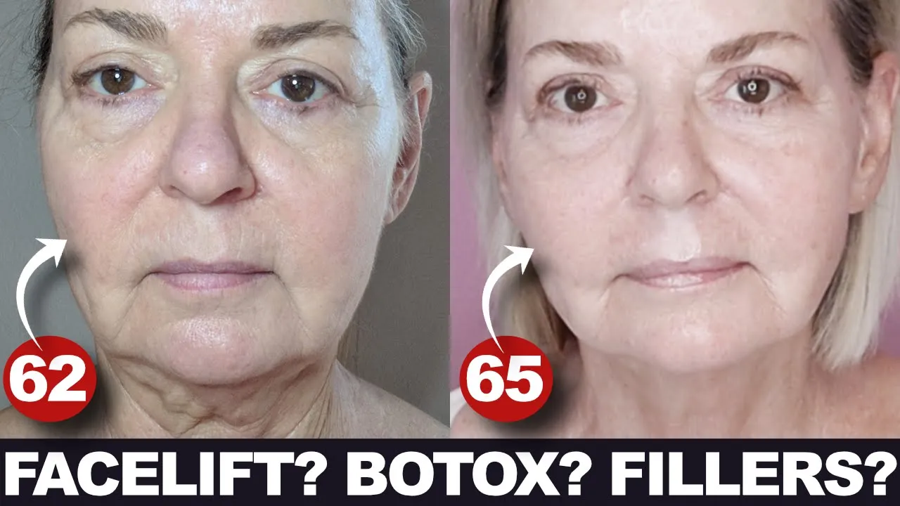 FACELIFT? BOTOX? FILLERS? - The Real Truth Over 50