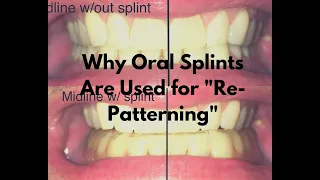 Download Why Oral Splints Are Sometimes Used During PRI Programs MP3