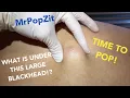 The Total Flake cyst See the Fluffy POP What has grown under that blackhead for all these years