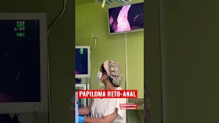PAPILOMA RETAL ! Não é Hemorróida. Dr.Fernando Lemos - Planeta Intestino