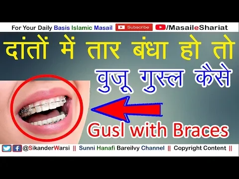 Gusul Wuzu on Braces | दातों में तार बंधा तो हो क्या वुज़ू ग़ुस्ल हो जायेगा | Teeth Braces Wuzu Gusul