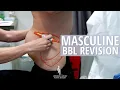 Male BBL Revision Transformation Results