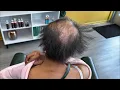 LIVE Salon Transformation Fixing a Bald Crown Area You Won t Believe This Makeover