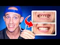 How Orthodontists deal with MISSING teeth Getting Braces and Invisalign
