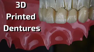 3D Printed Dentures - What Why How